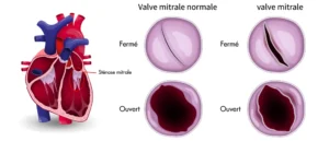 rétrécissement mitral
