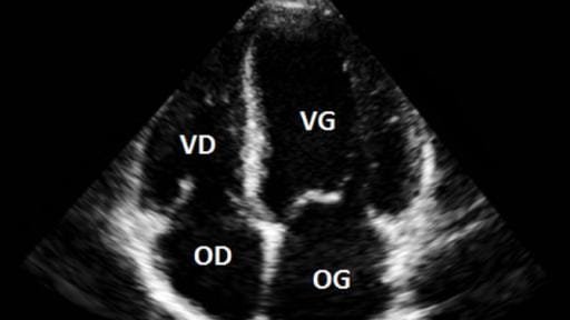 Échocardiographie Trans Thoracique Adulte